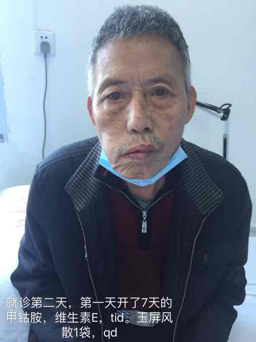 我的2016年12月30日诊间日记中枢性面瘫的治疗