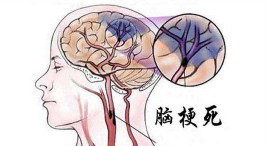 记忆力下降竟然是脑中风怎么应对