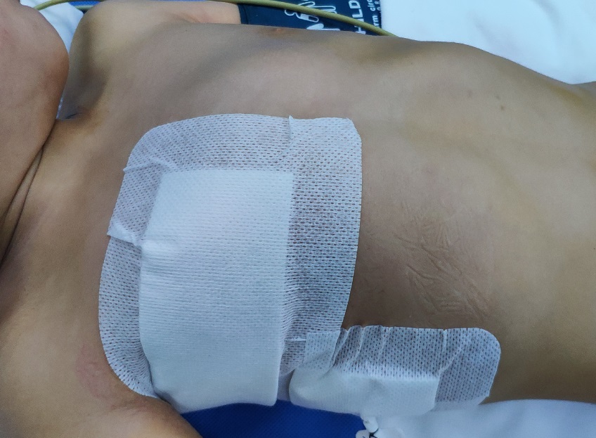 将该疾病分为3型:Ⅰ型, 肋骨缺如伴脊柱侧凸;Ⅱ型,肋骨融合伴脊柱侧凸