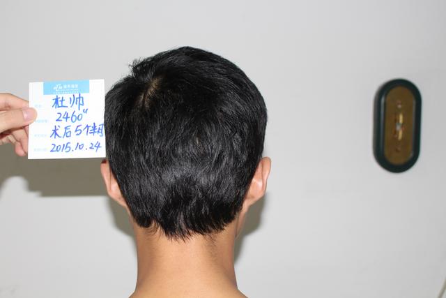 90后杜先生三级脱发5个月后是这样