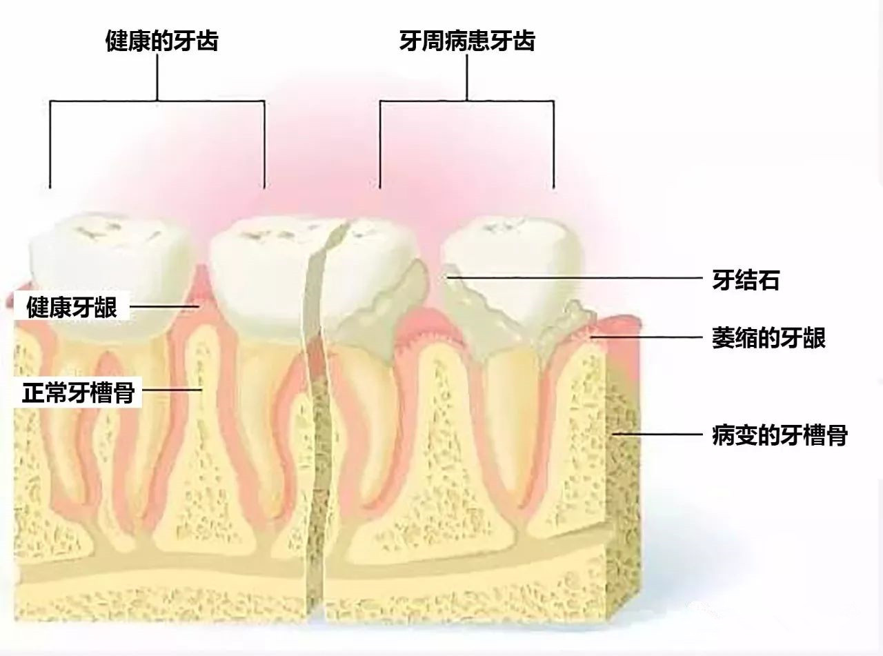 牙龈红肿,有口臭有这些症状的朋友,有可能