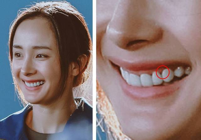 牙齿上的隐秘黑三角我还有机会恢复么