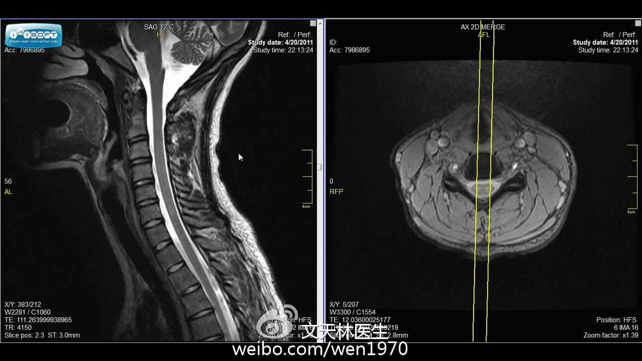 此图为正常成人颈椎核磁共振图像,左侧为矢状位,即劈开左右两半的图像