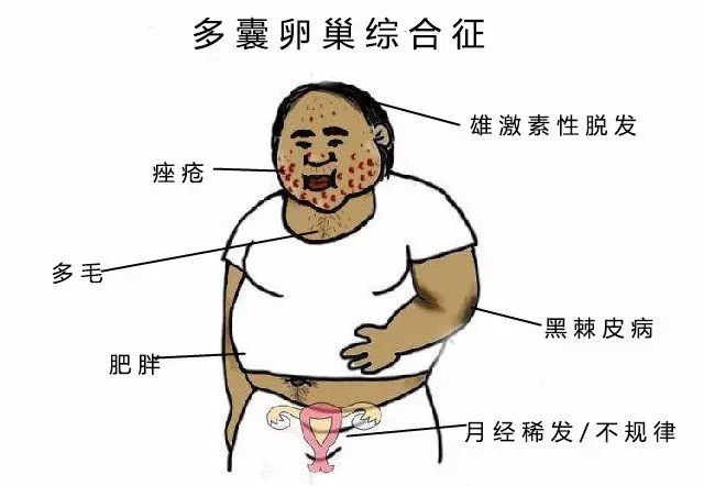 在pcos患者中,50%-60%的人合并肥胖的问题,也就是俗称的胖多囊,相对