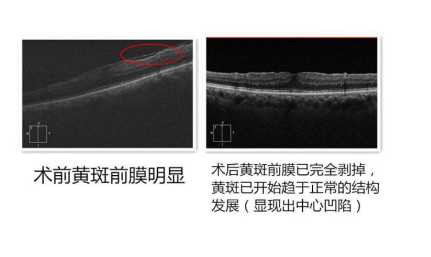 案例丨从0 01到0 7 视力提升的背后 林顺潮 爱问医生