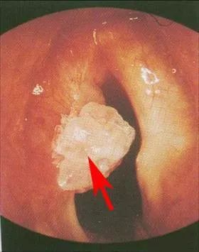 咽喉菜花状肿瘤图片