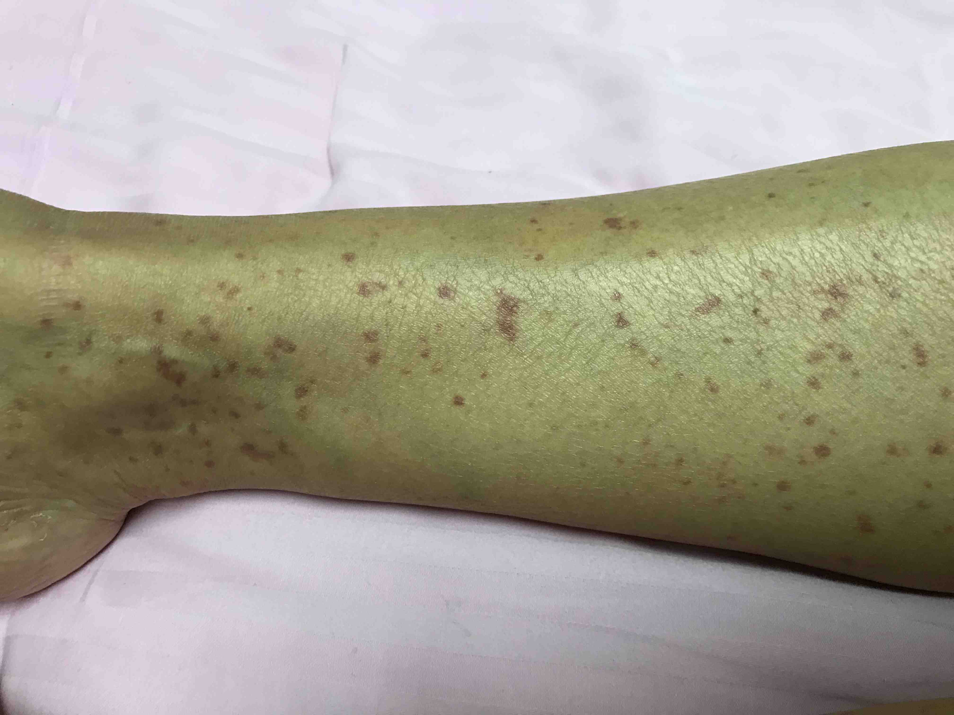 过敏性紫癜不是过敏引起的真的