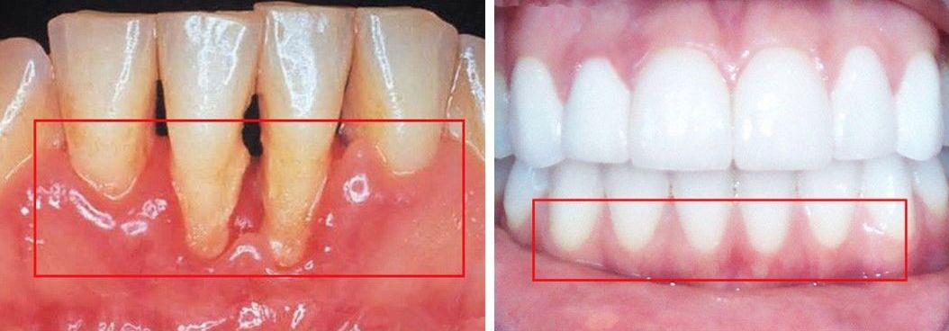 牙齿上的神秘"黑三角"究竟是怎么回事?-赵越-爱问医生
