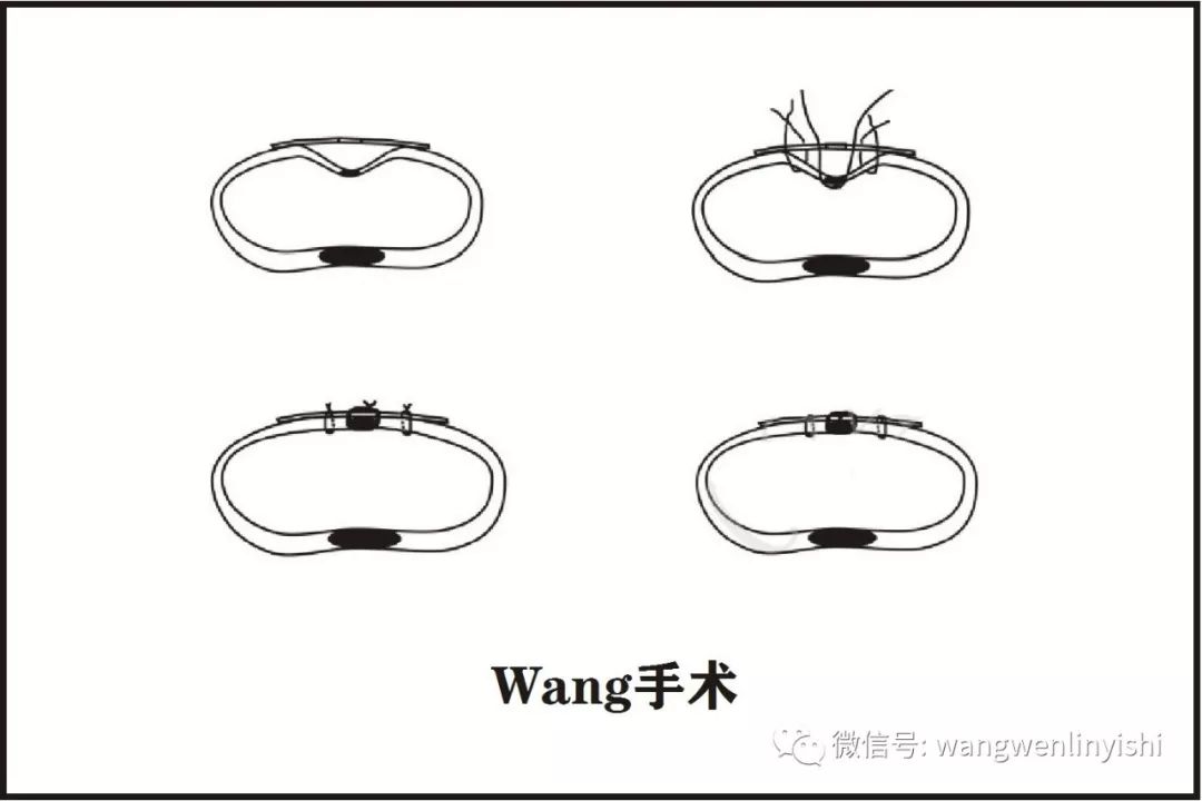(wang手术是完全不同于nuss手术的新术式,因批判nuss手术而问世,于