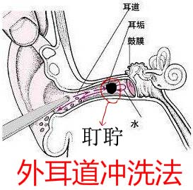 经常挖耳可致耵聍栓塞 高翔主治医师 爱问医生