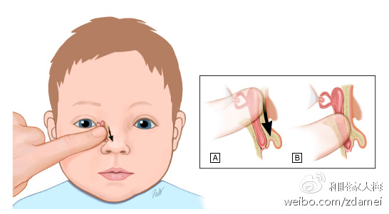移除按压泪囊,向鼻腔方向,向下按压移除泪囊按摩方法如果宝宝6个月后