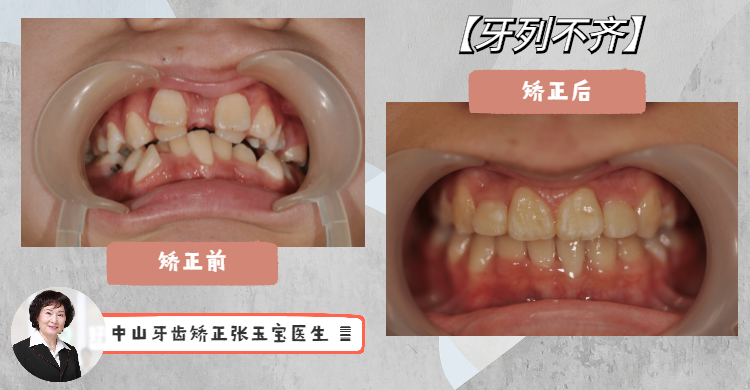 医生心得 牙齿情况:双排牙,牙列拥挤,异位重叠 患者年龄:14岁 矫正