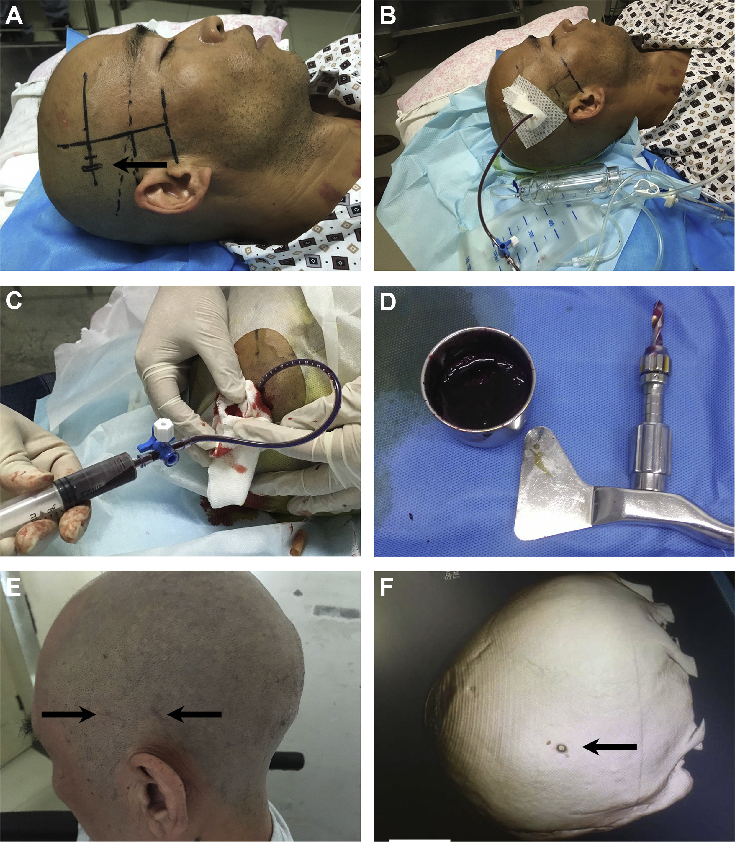 由于保守治疗脑出血仅预防再出血和脱水降颅压,而穿刺治疗脑出血有助