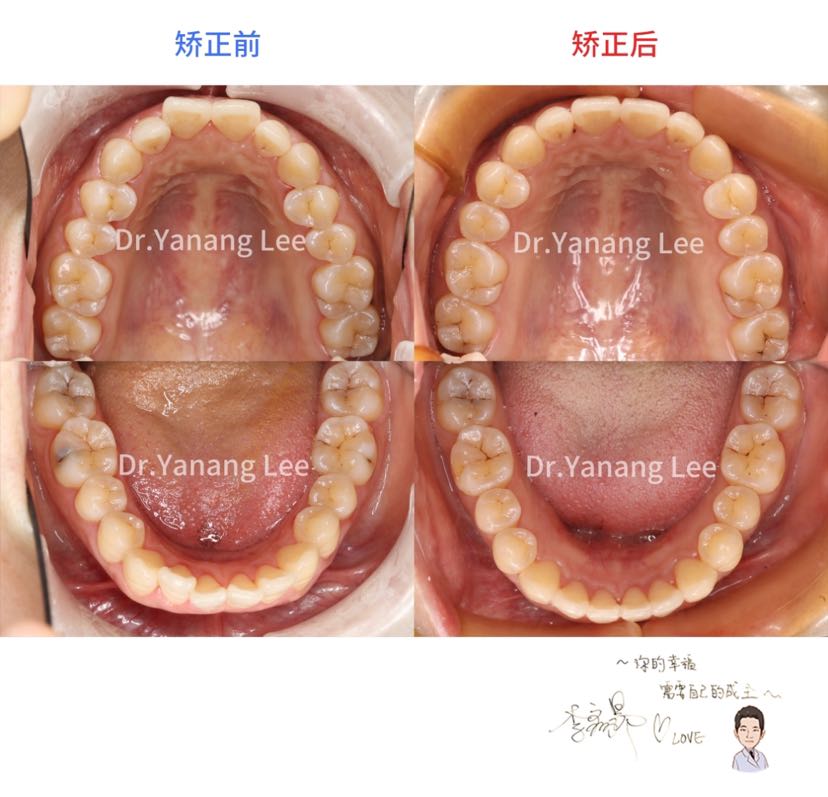 推磨牙向後改善嘴突隱適美矯正案例