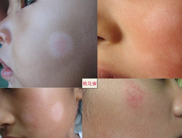 面部干性糠疹,链球菌性糠疹和链球菌性红斑,俗称桃花癣,虫斑,以