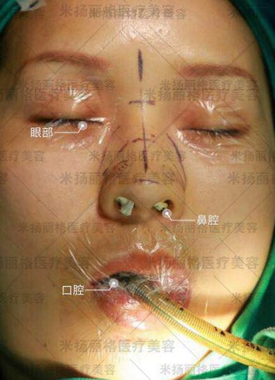 膨体真的容易感染吗?膨体偏见知多少_巫文云_副主任医师_爱问健康