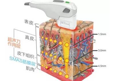 超声刀作用原理: 它以高强度聚焦式超声波,于皮下作用的温度可达65