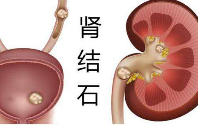 因為當結石從腎臟掉下來卡在輸尿管某個狹窄的位置引起痙攣,疼痛時,可