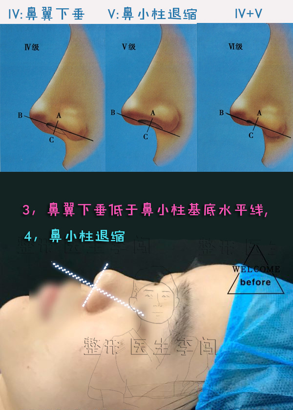 高难度鼻整形:鼻基底凹陷 下巴后缩 鼻翼下垂 鼻小柱退缩