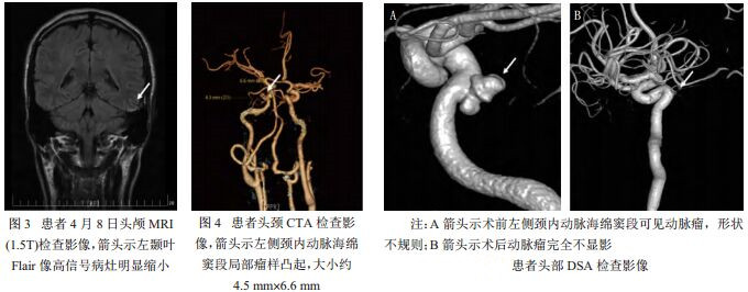 經全腦血管造影證實,是右頸內動脈海綿竇瘻形成,並伴有巨大假性動脈瘤