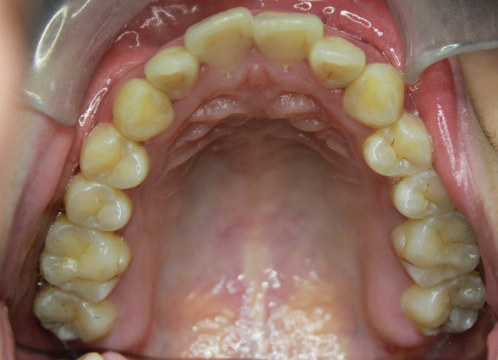 拔除4颗第一前磨牙,支抗钉协助下利用拔牙空间内收前牙,使下颌骨逆