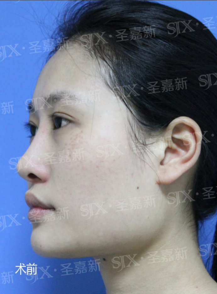 下颌角长曲线截骨,并同时处理咬肌,缩窄正面宽度,进一步改善国字脸