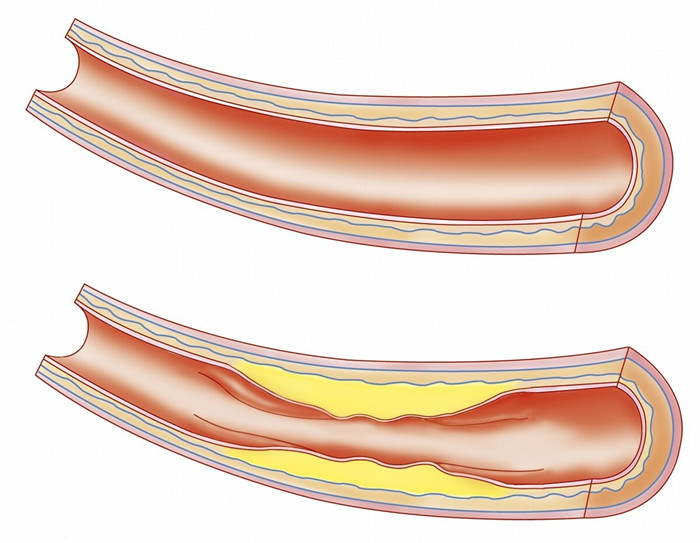 一,血管斑塊是怎麼形成的?