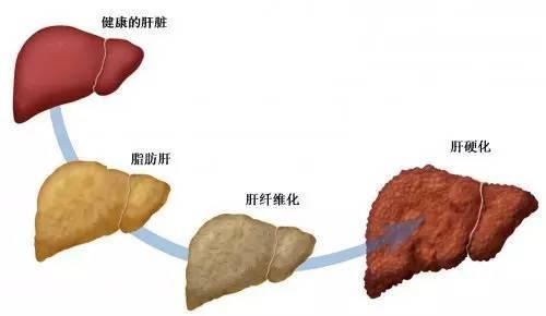 谈谈肥胖和脂肪肝要抓紧治疗啦