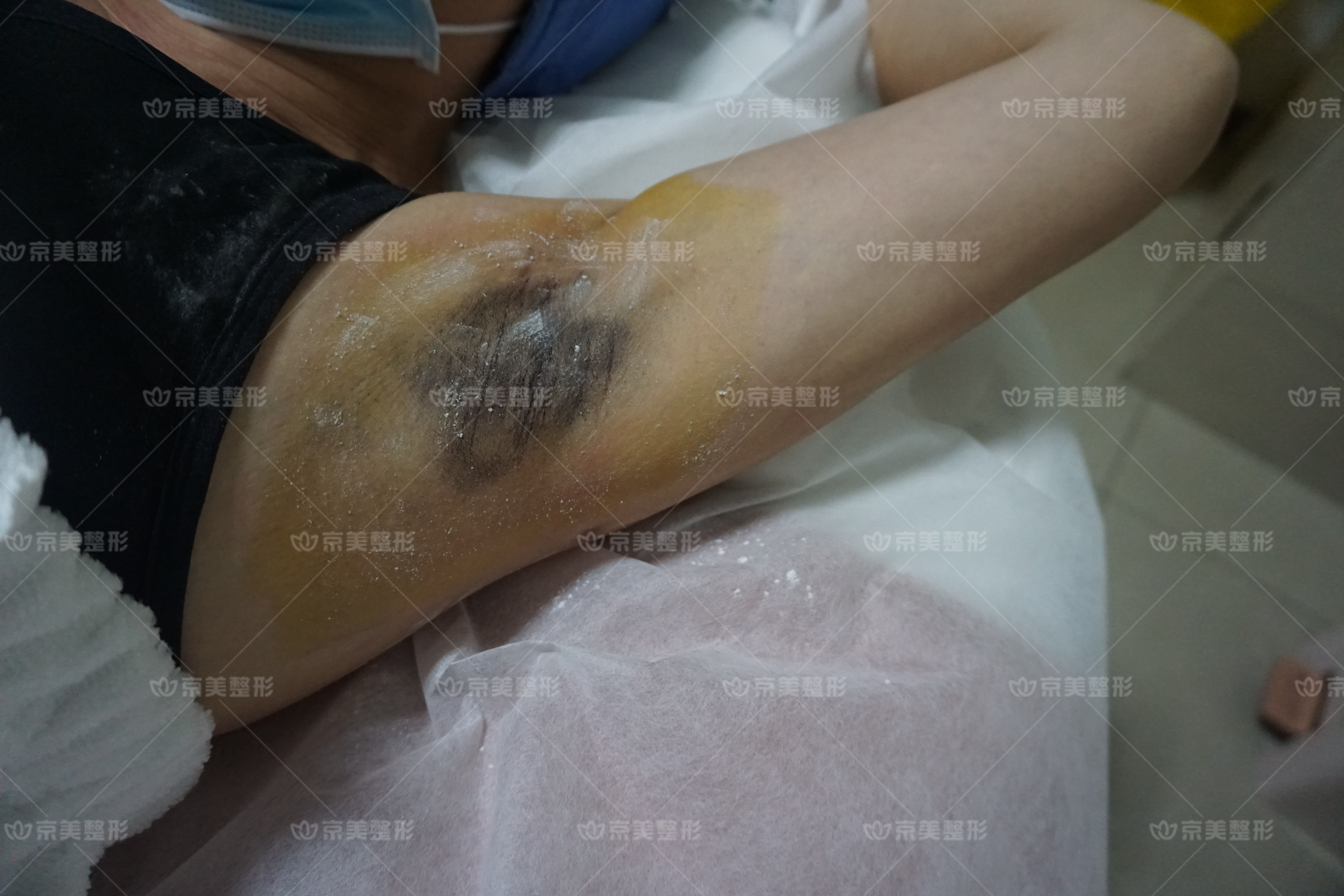 夏季除腋汗狐臭的最佳方法miradry