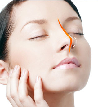 自体肋软骨易塑形垫高鼻梁还你精致挺拔