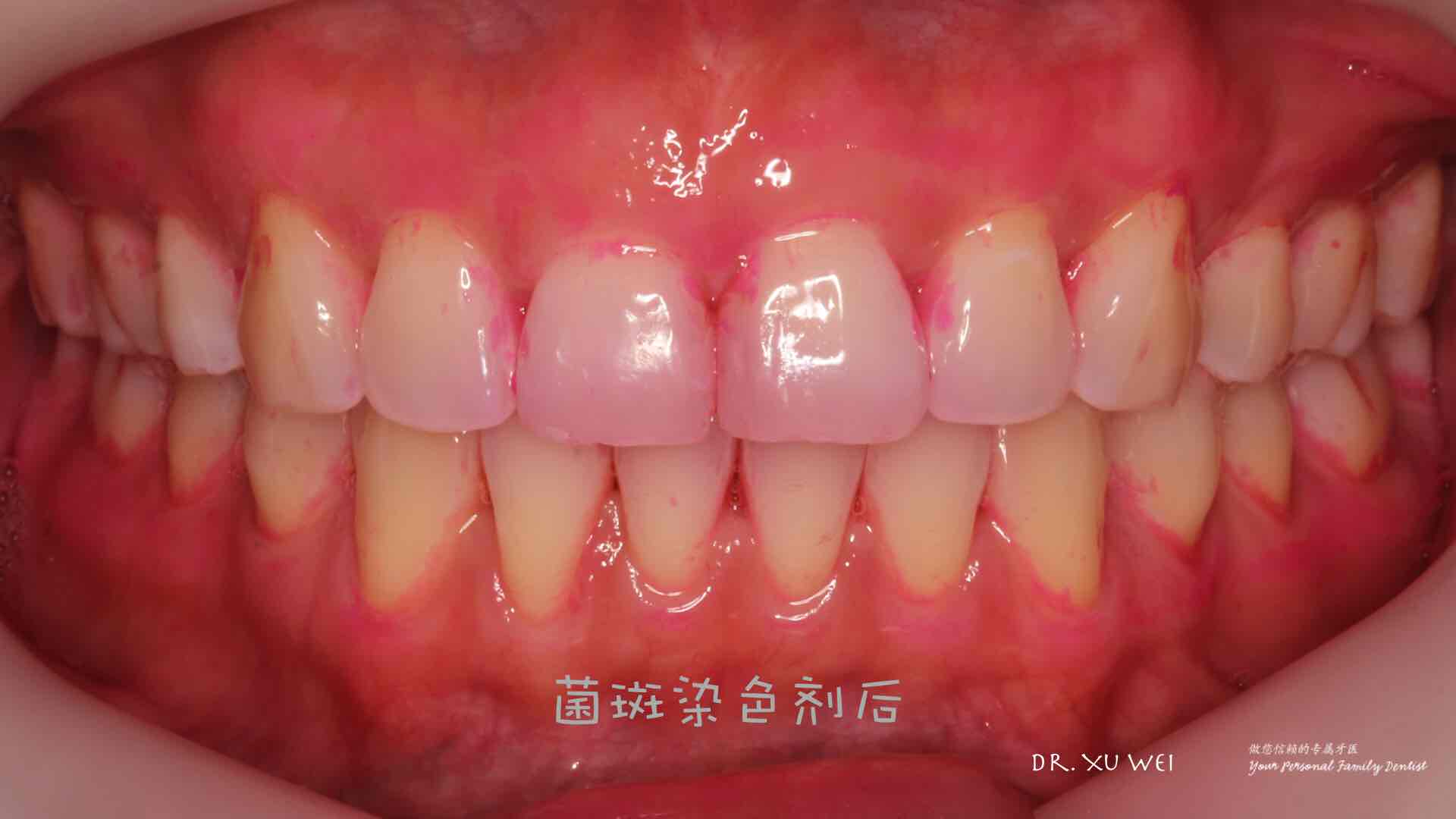 可以把大块的食物残渣漱掉;牙齿看起来似乎挺干净的,我们用菌斑显示剂