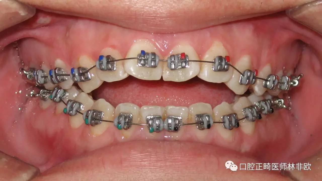 隐形矫治器治疗,美观舒适,原理与固定矫治器相似