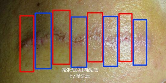 减张贴的正确使用方法