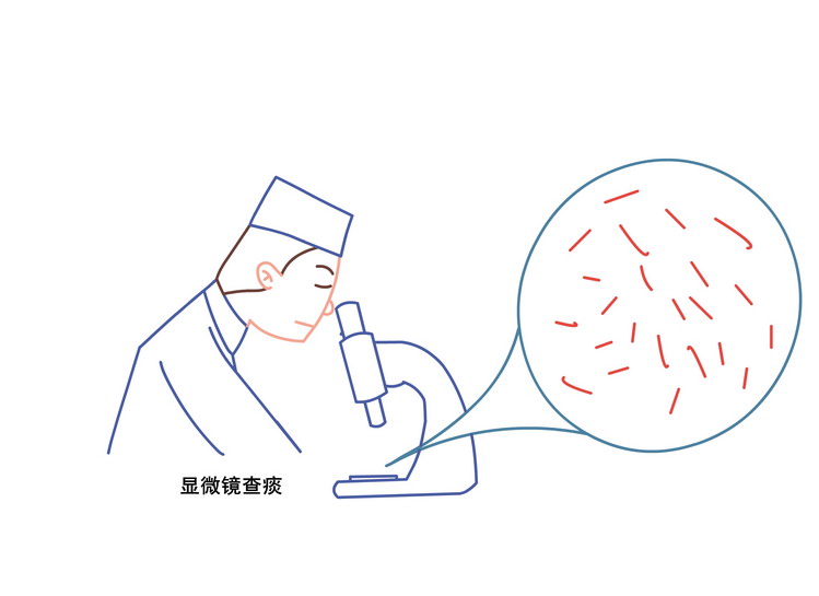 怎么办?怎么办?1,肺结核结核病是由结核分枝杆菌引