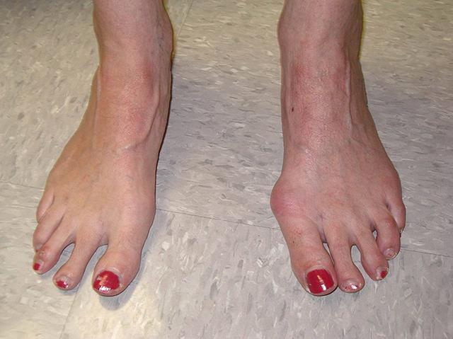 看了上图这位医生的足部外观图后,我们应该知道:对于严重拇外翻的诊断