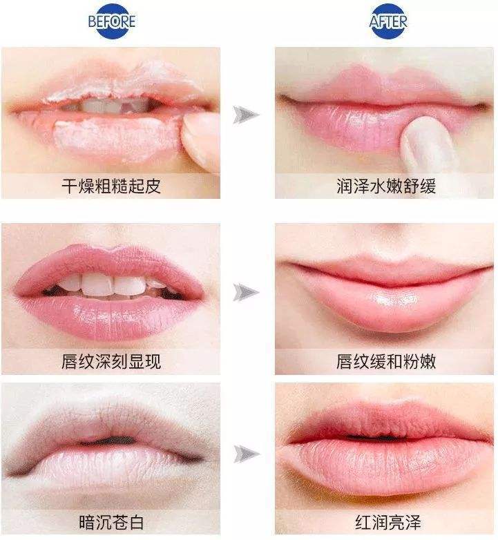 叶文珏医生|玻尿酸丰唇后,接吻会不自然?