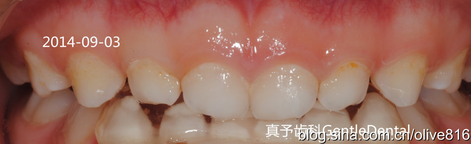 乳牙反合联冠斜导矫正过程照片一例
