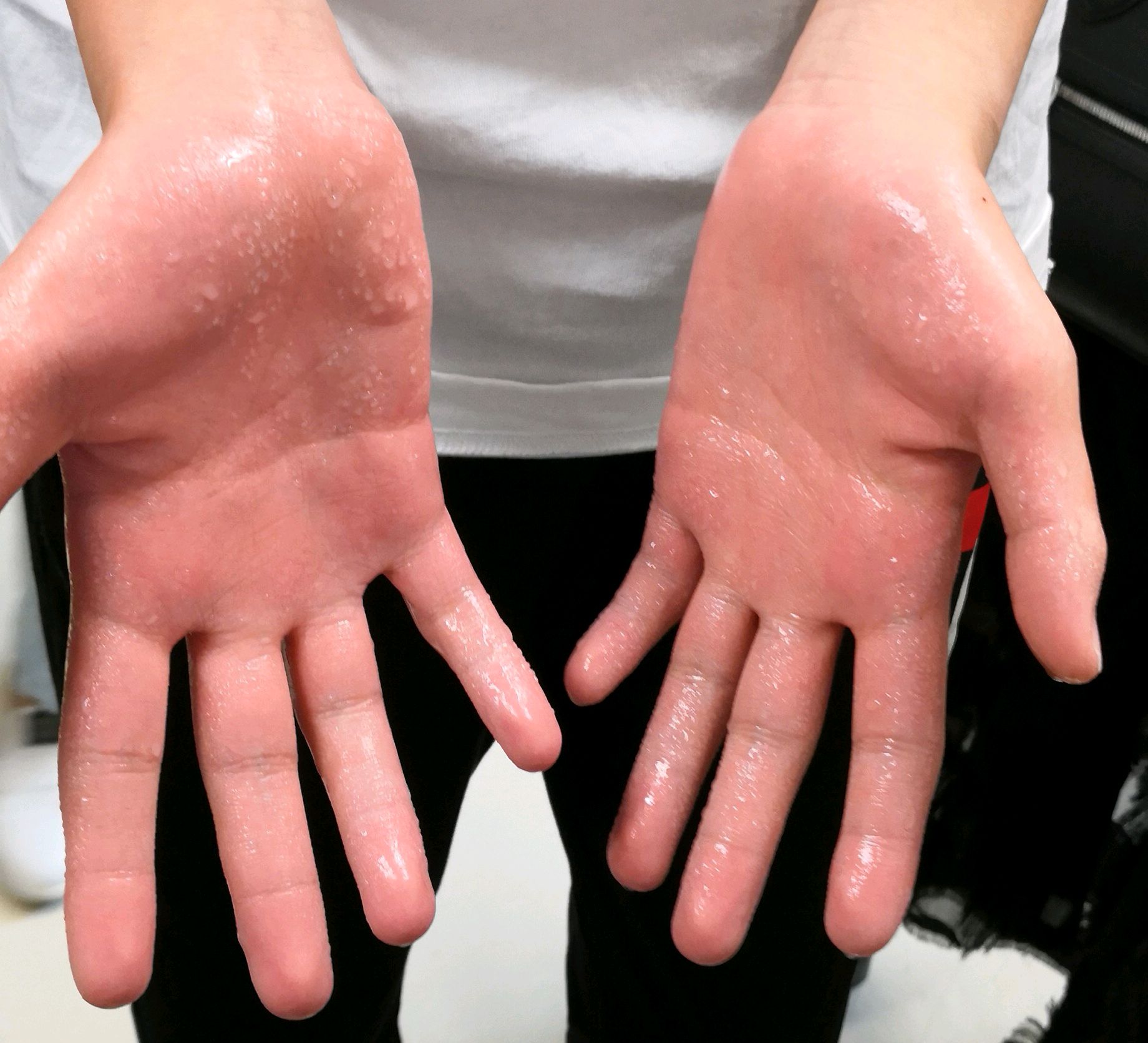 它摧毁了我所有的信心!我是一名手汗症者 去年12月份做的手术,做