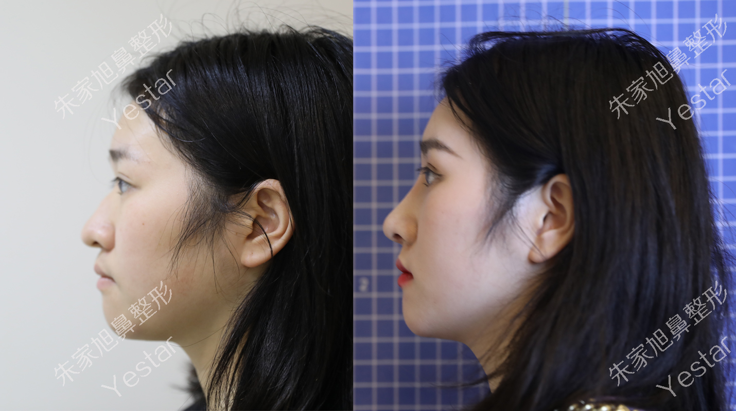 使歪鼻得到矫正,采用肋软骨支架塑鼻尖,改善鹰钩鼻和鼻头肥大问题