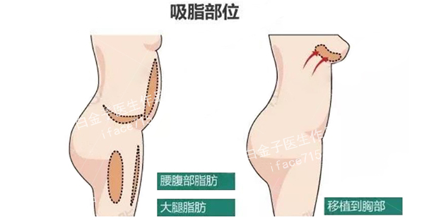 常见吸脂部位示意图,腰腹部吸脂,大腿吸脂,脂肪整形白金子医生2.jpg