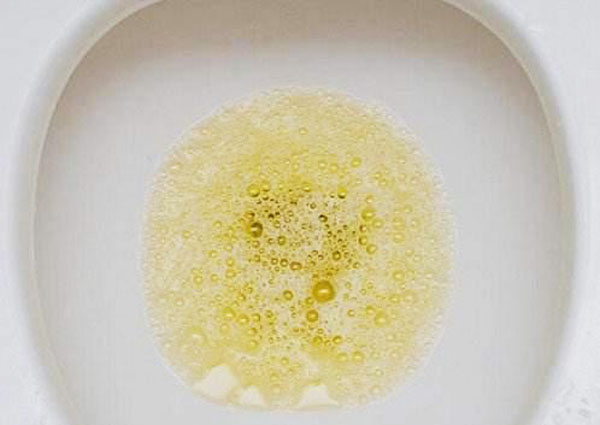 肾炎患者的尿液图片图片