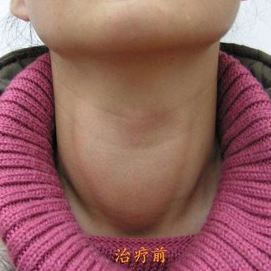 女性脖子中间肿大图片