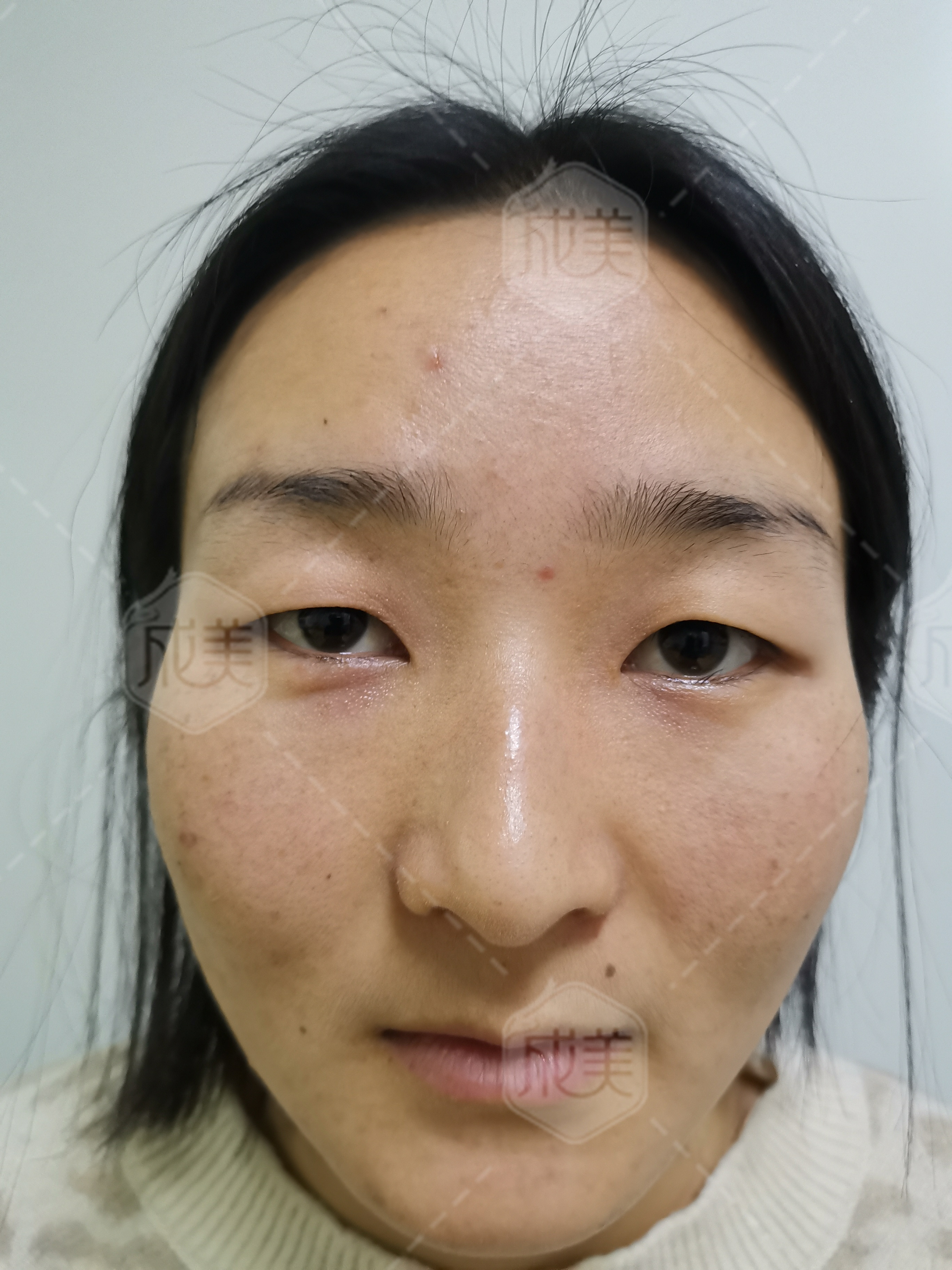 黑眼球小,开完眼角后,眼睛看起来会不会不好看?