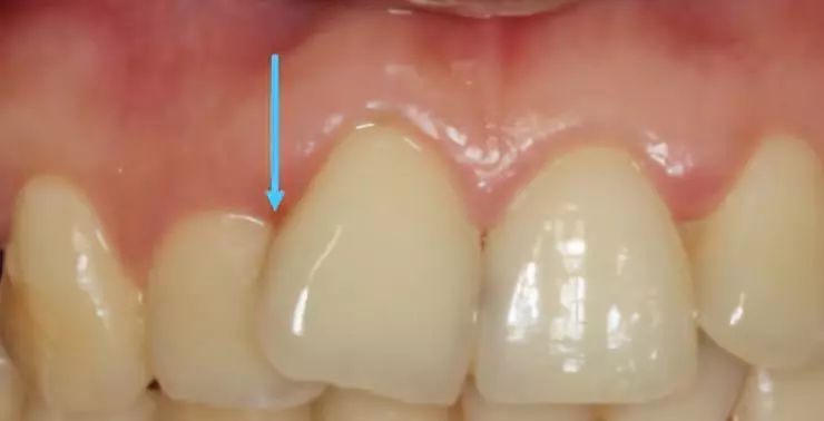 相邻牙齿间过大的间隙就暴露了,将导致明显的牙龈黑三角