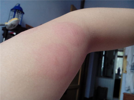 儿童身上的皮疹都是什么病