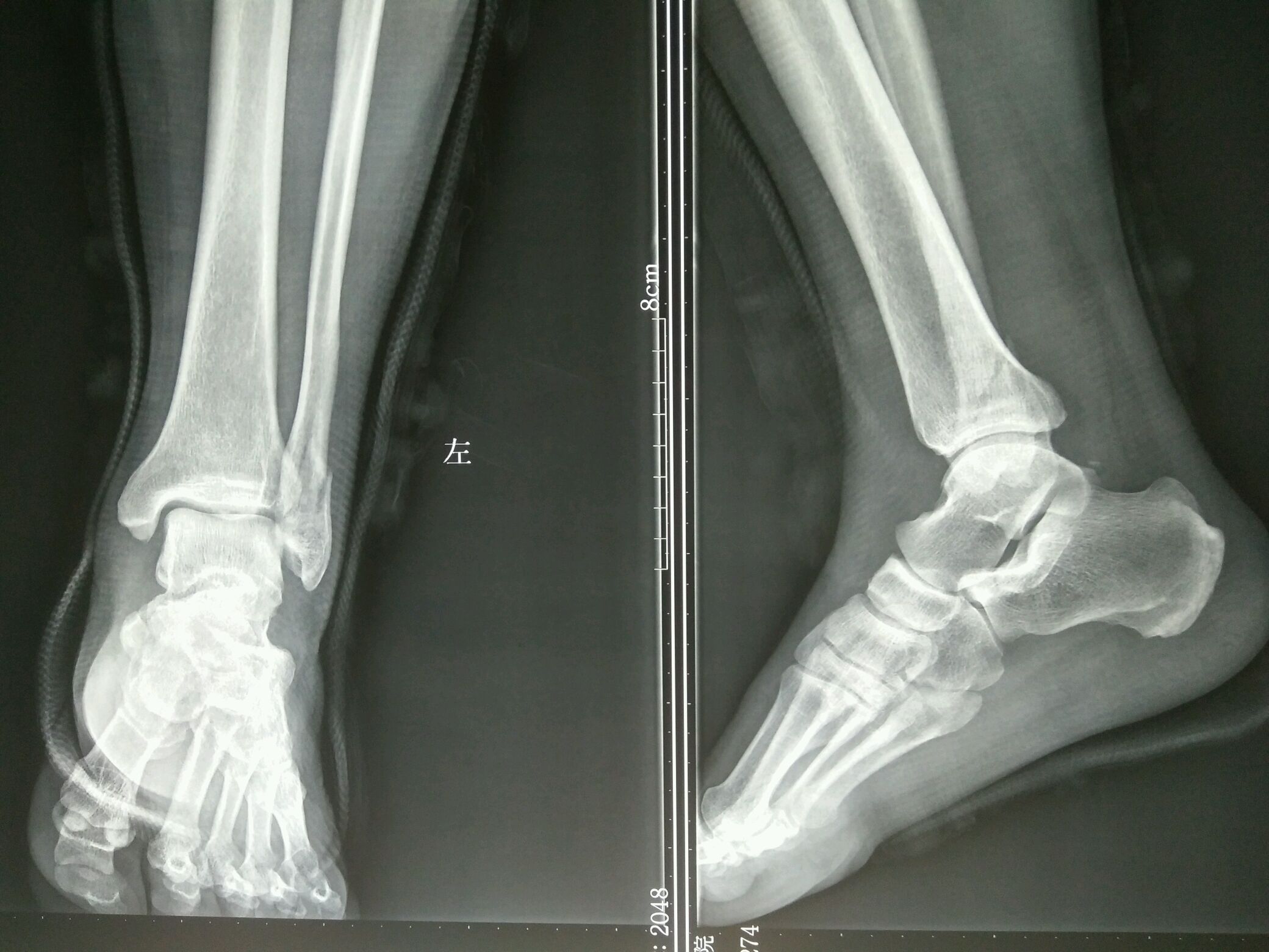 十天后病人再次来我院复查x线片如下复位后踝关节脱位得以纠正,但外踝
