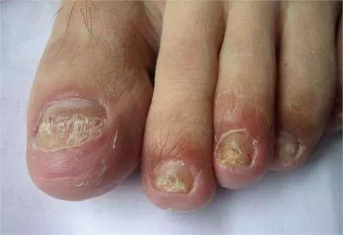 灰指甲甲萎缩