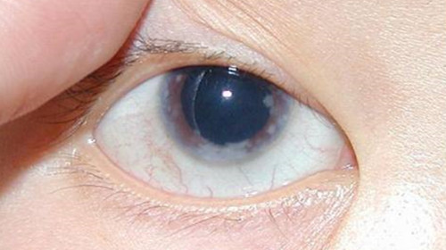 以免患上激素性青光眼