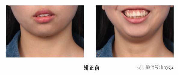 矫正案例分享有一种天仙bug叫做露龈笑