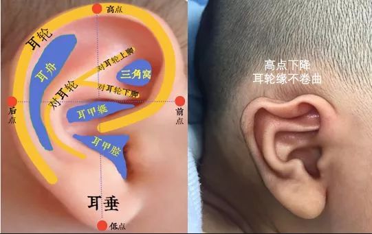 一招教您判断 宝宝的耳廓是否畸形?